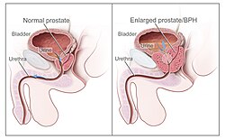 Imagen ilustrativa de Hiperplasia Benigna de Próstata: Síntomas, Causas y Tratamiento