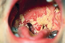 Imagen ilustrativa de Candidiasis Oral: Tipos, Síntomas y Clasificación