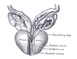 Imagen ilustrativa de Válvula Uretral Posterior: Causas, Diagnóstico y Tratamiento
