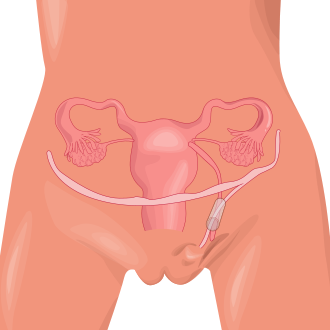 Imagen ilustrativa de Canal de Nuck: Definición, Causas y Relación con Hernias