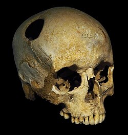 Imagen ilustrativa de Trepanación: Historia y Prácticas de la Cirugía Craneal