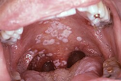 Manifestación de candidiasis oral