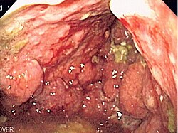 Diagnóstico del cáncer de estómago