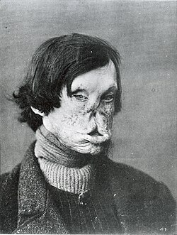 Rostro severamente deformado por la lepra