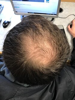 Imagen ilustrativa de Alopecia Androgenética: Causas, Síntomas y Tratamientos